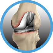 knee revision resurgery