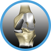 mako partial knee replacement