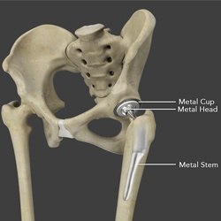 Total Hip Replacement