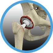 Revision Hip Replacement