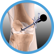 knee arthroscopy