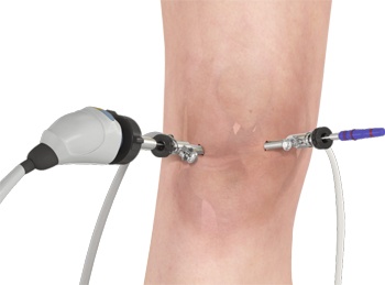 knee arthroscopy