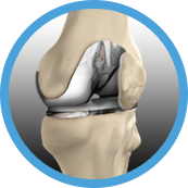 knee replacement