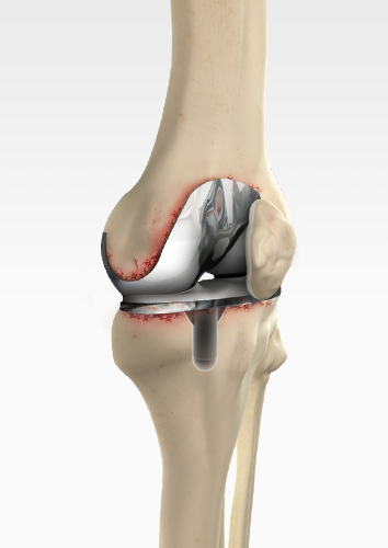 revision-knee-replacement