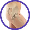 Anterior Approach Hip Replacement