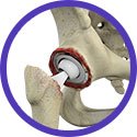 Revision Hip Replacement