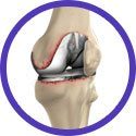 Knee Arthroscopy