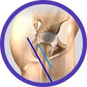 Minimally Invasive Hip Surgery