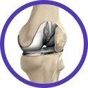 Total Knee Replacement