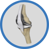outpatient Total knee replacement